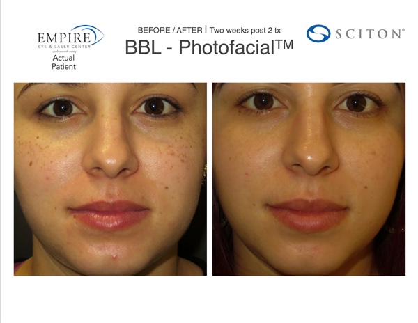 Known as the "lunchtime photofacial," make-up can be applied imme...