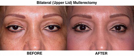 Upper Eyelid Blepharoplasty/Ptosis REpair | Empire Eye and Laser Center