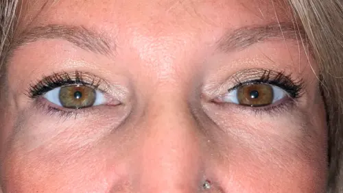 Upper Eyelid Blepharoplasty Bakersfield - After