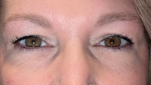 Upper Eyelid Blepharoplasty Bakersfield - Before